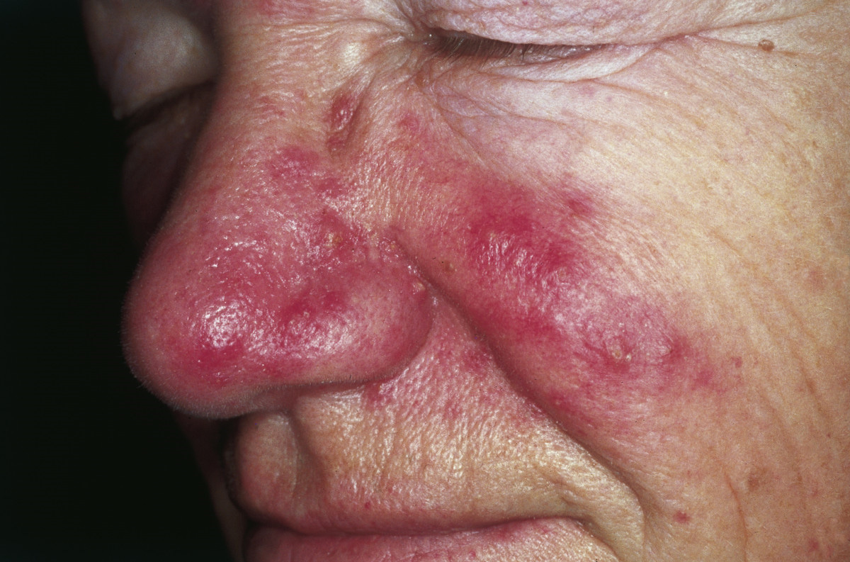 genetic-basis-of-rosacea-identified-by-researchers-news-center