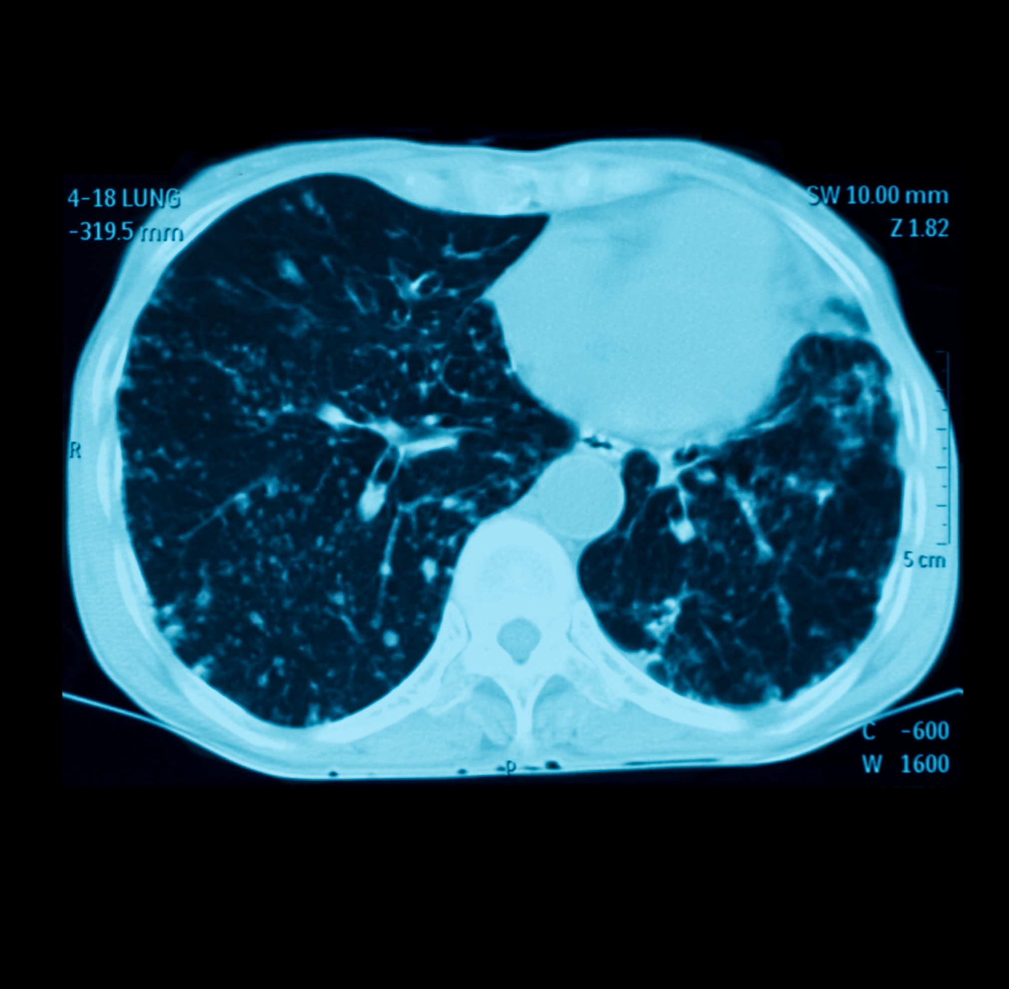 Lung cancer screening guidelines perpetuate racial disparities, Stanford-led study finds | News Center