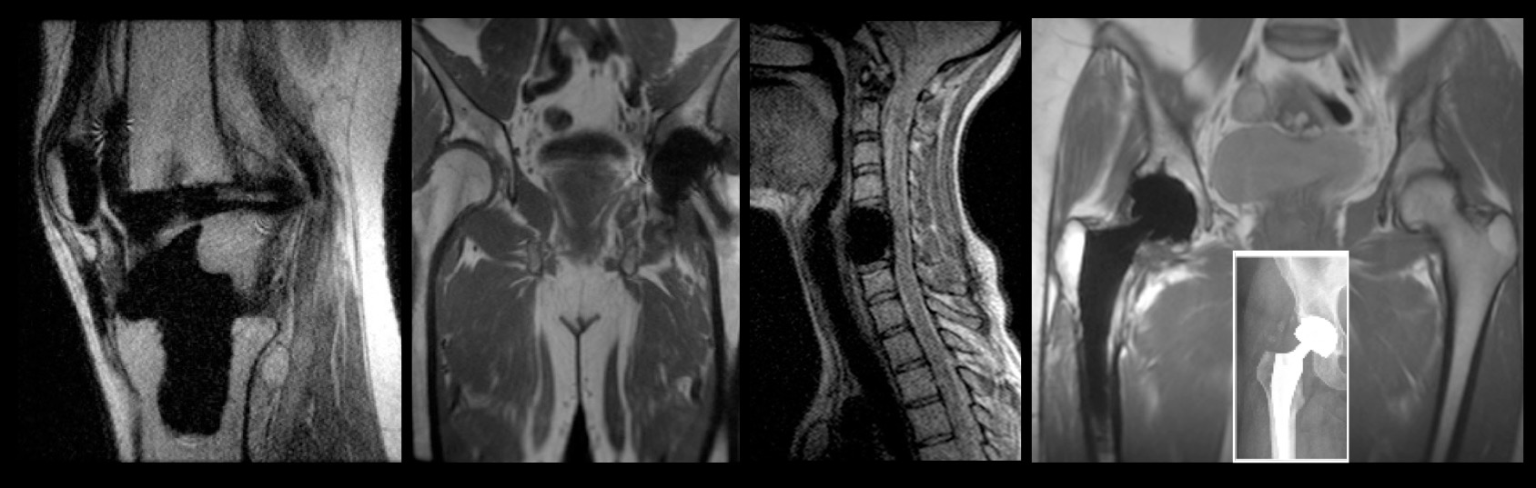 MRI Metal | Body MRI Research Group (BMR) Medicine