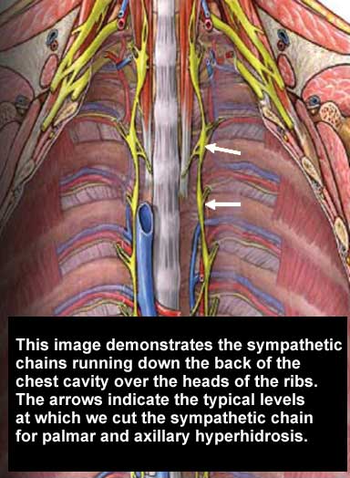 Thoracoscopic (VATS) Sympathectomy for Hyperhidrosis | Department of