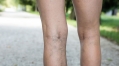 Height may be risk factor for varicose veins