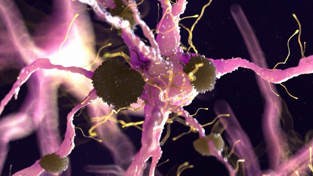 Illustration of amyloid plaques on a nerve cell. Credit: Getty Images