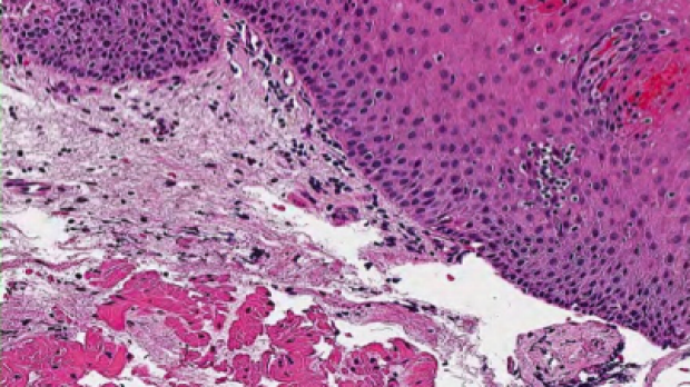 Stain of proximal esophagus (high power) taken from a biopsy.
