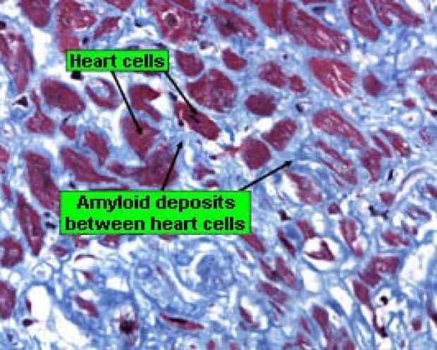 alprimaryamyloidosis-photo-heart2