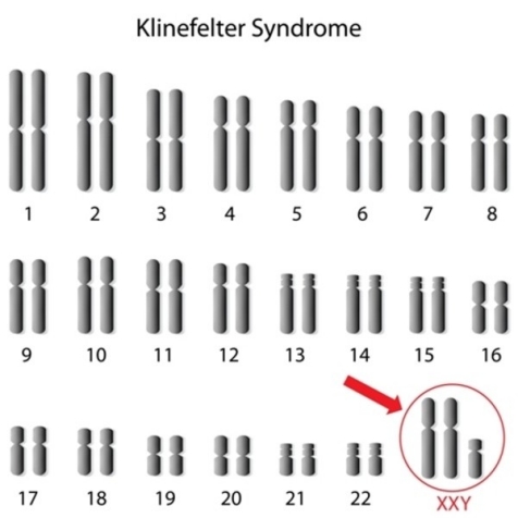 Medical Biology - Klinefelter Syndrome Other name: XXY Symptoms: People  with a XXY karyotype are males with an extra X chromosome. These  individuals are typically tall, with long arms and legs, have