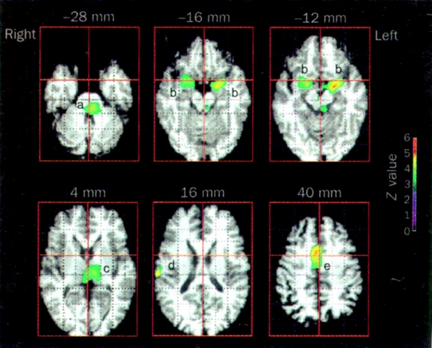 MRI Brain images