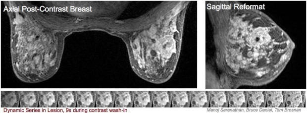 Dynamic Contrast-Enhanced Breast MR Images