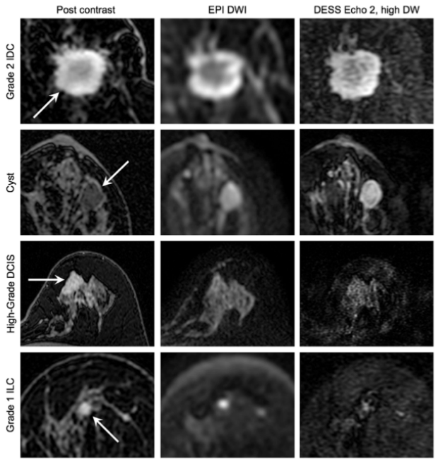 Comparison of Diffusion-Weighted Breast Images