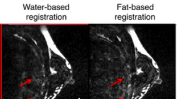 Fat-Based Registration of Breast Dynamic Contrast Enhanced Water Images
