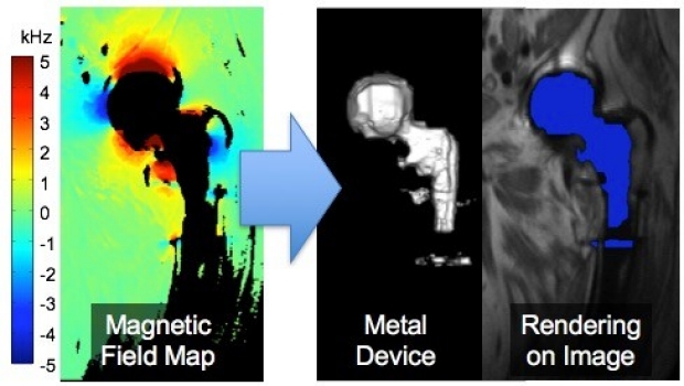 Metallic Implant Estimation Using Susceptibility Mapping