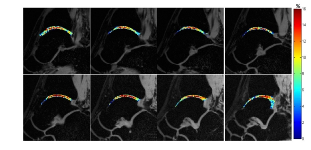 Rapid Volumetric MRI of Cartilage Biochemistry