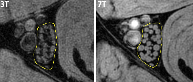 MRI of Peripheral Nerves