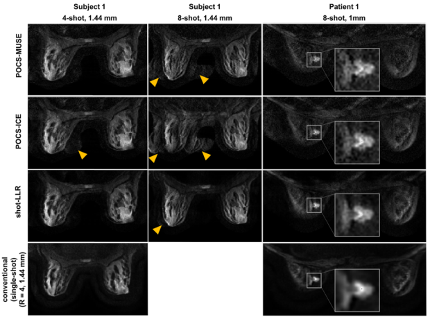 Multi-shot diffusion-weighted imaging with locally low-rank regularization