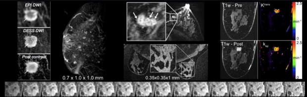 Example Breast MRI Images