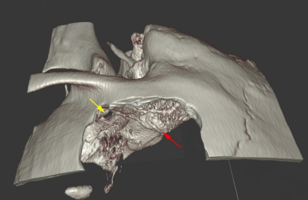 Simulated view of surgical procedure