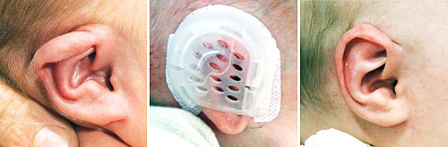 Use of Tapes in Ear Deformities Babies - Dr. Onganlar