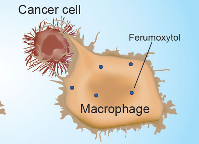 Iron nanoparticles make immune cells attack cancer