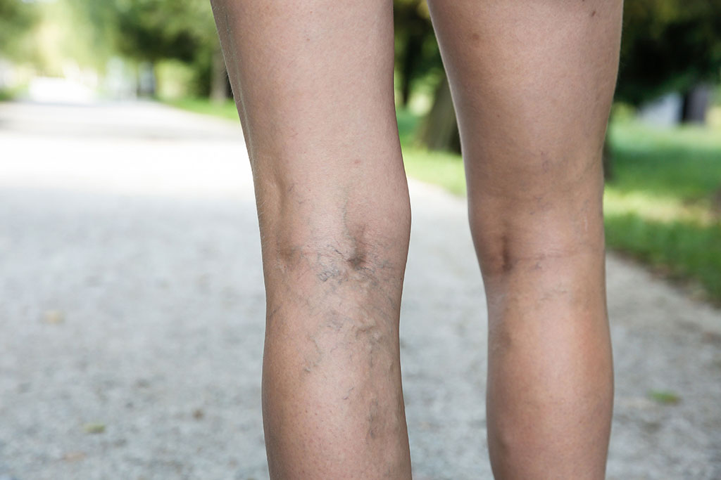 Occupations Most at Risk for Varicose Veins - How to Help