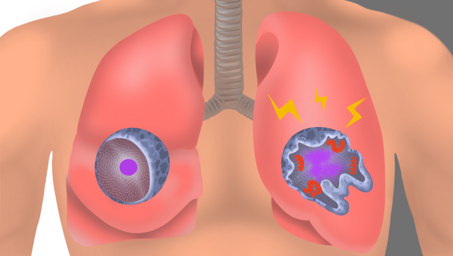 Stanford Medicine study flags unexpected cells in lung as suspected source of severe COVID