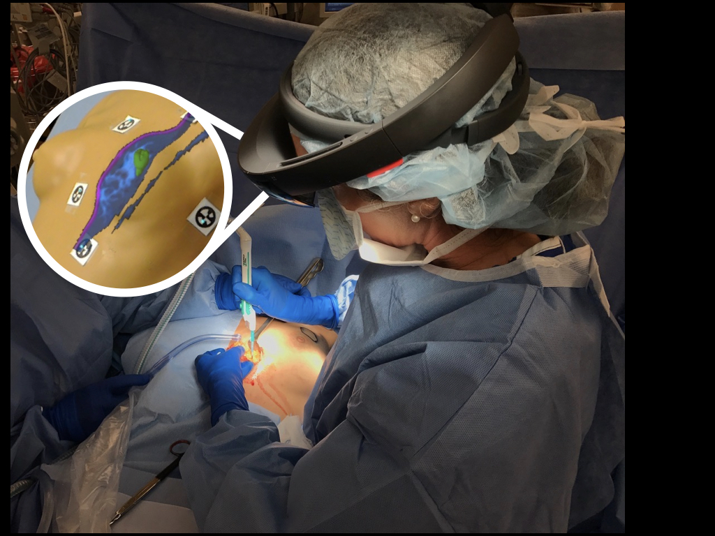 A Mixed-Reality System for Breast Surgical Planning