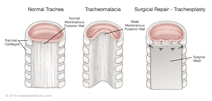 Diseases of the Trachea and Airway | Department of ...
