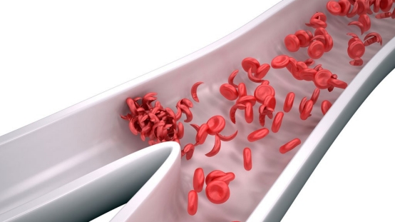 Researchers take step toward gene therapy for sickle cell disease