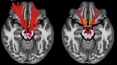 Key social reward circuit in the brain impaired in kids with autism