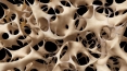 Osteoporosis, fracture risk predicted with genetic screen