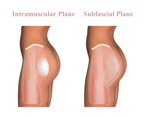 gluteal_implant