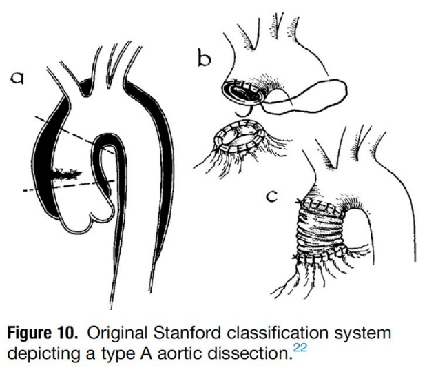 type A aortic dissection