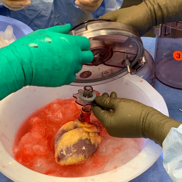 Donor heart being removed from CTS box