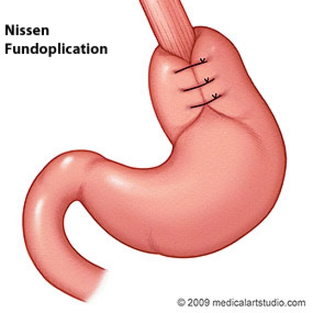 medical illustration of a Nissen fundoplication
