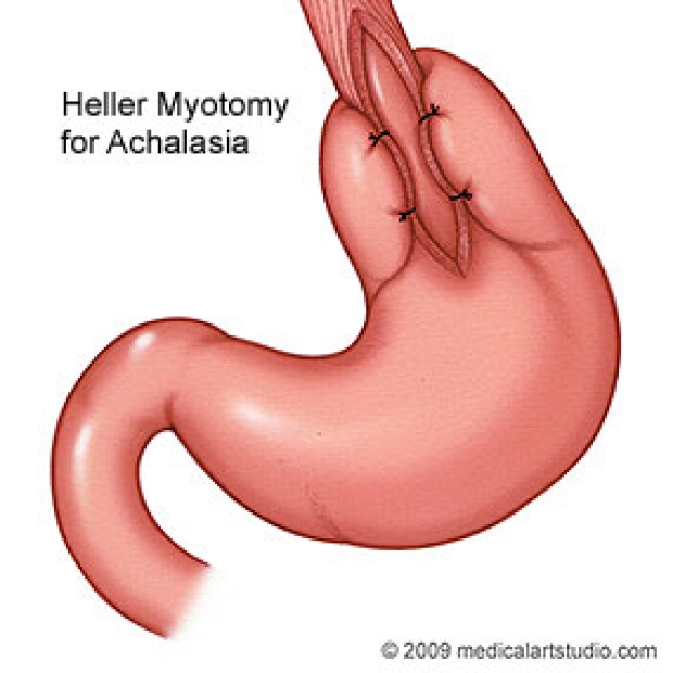 medical illustration of a Heller myotomy for Achalasia