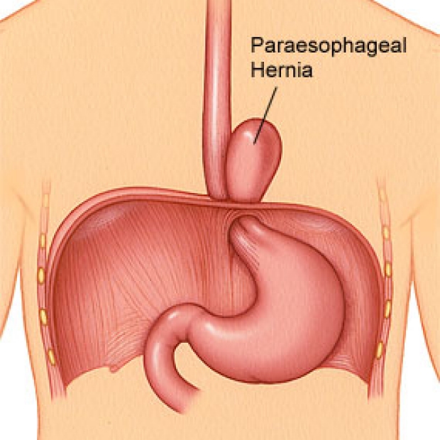 medical illustration of a paraesophageal hernia