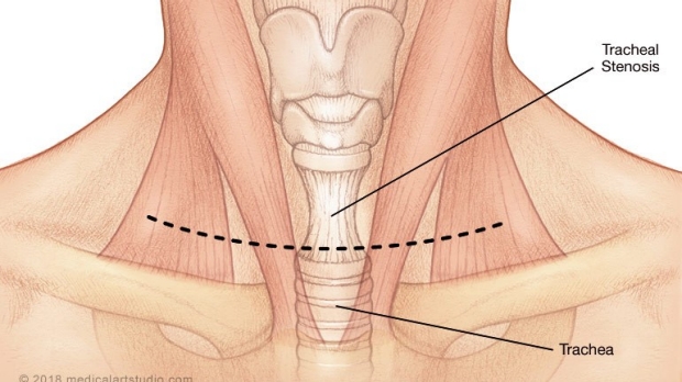 medical illustration of a tracheal stenosis