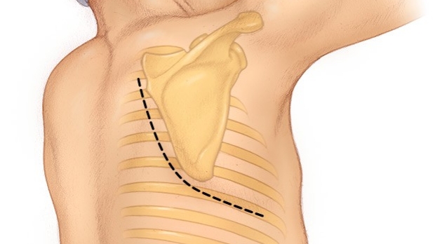 medical illustration of a thoracotomy