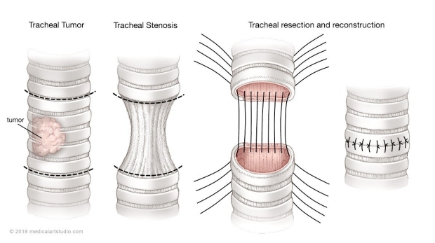 medical illustration of a tracheal resection and reconstruction