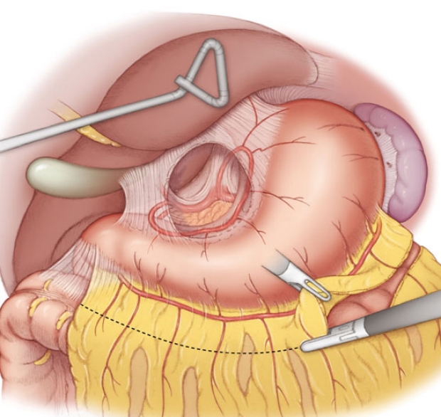 medical illustration of Division of the Gastro-Colic Ligament during laparoscopic mobilization of the stomach