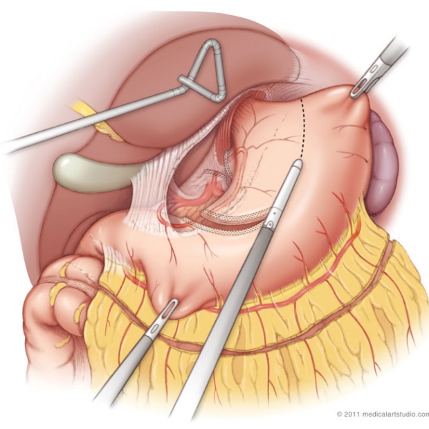 medical illustration of Laparoscopic preparation of the gastric conduit (Neo-esophagus).