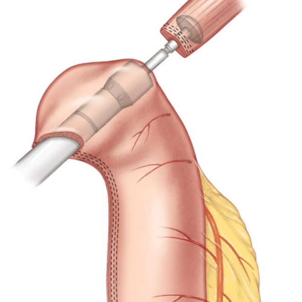medical illustration of an esophago-Gastric anastomosis with a circular stapler