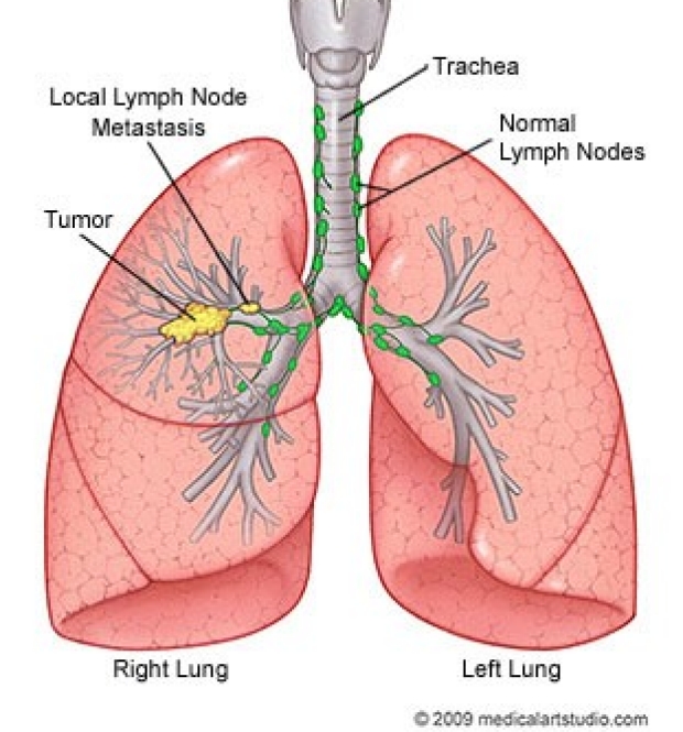 medical illustration of lungs with tumor