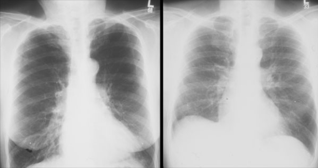 Chest x-rays before and after LVRS