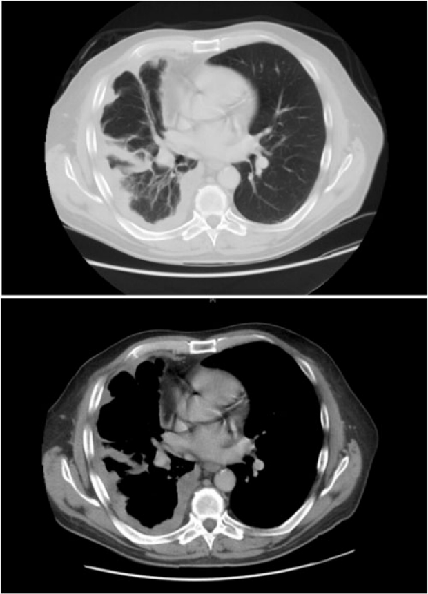 CT scan of thickening of the pleura