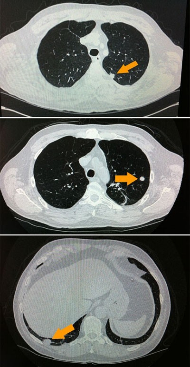 Three computed tomography (CT) images showing three discreet lung nodules in a patient with lung metastasis that spread from cancer of the tonsil