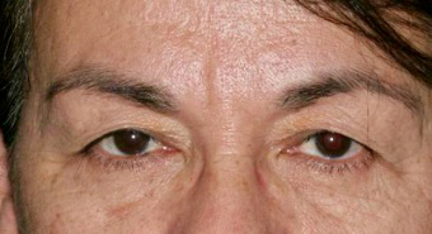 55-64 year old woman before Brow Lift and Upper Blepharoplasty