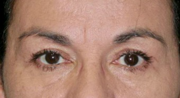 55-64 year old woman treated with Brow Lift and Upper Blepharoplasty
