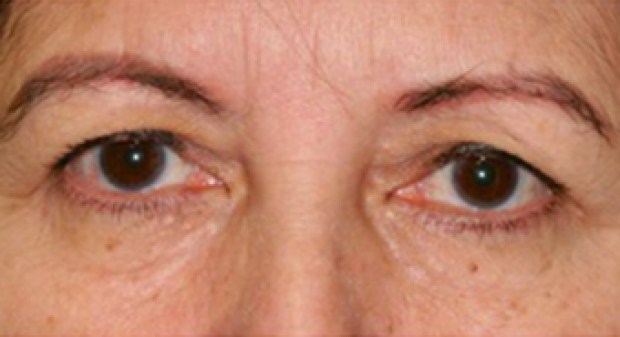 55-64 year old woman before Endoscopic Brow Lift and Upper Blepharoplasty