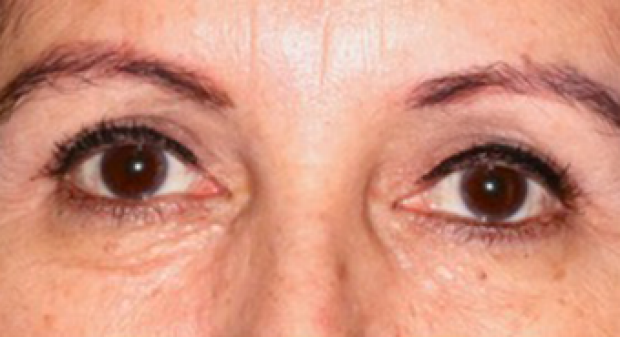 55-64 year old woman treated with Endoscopic Brow Lift and Upper Blepharoplasty