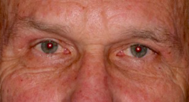 55-64 year old man treated with Brow Lift and upper blepharoplasty