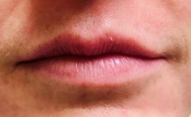 35-44 year old woman before Lip Augmentation